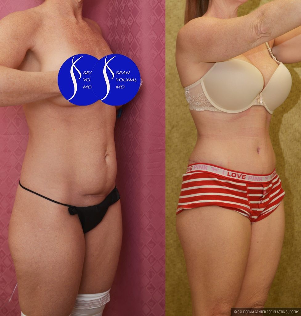 Tummy Tuck (Abdominoplasty) Small Size Before & After Patient #14918