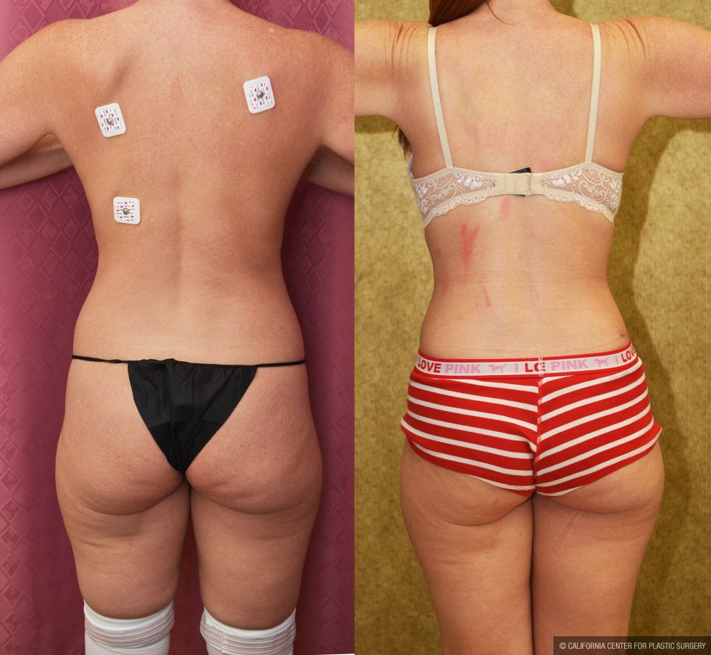Tummy Tuck (Abdominoplasty) Small Size Before & After Patient #14918