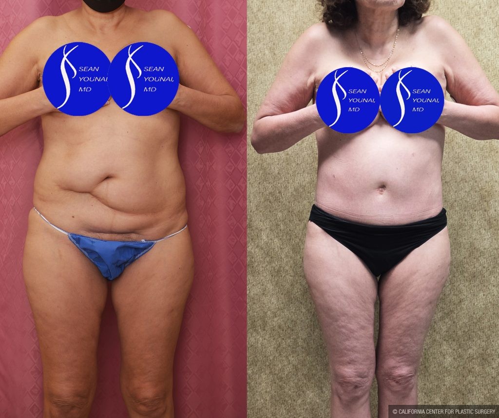 Tummy Tuck (Abdominoplasty) Small Size Before & After Patient #14919