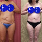 Tummy Tuck (Abdominoplasty) Small Size Before & After Patient #14919