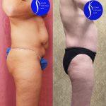 Tummy Tuck (Abdominoplasty) Small Size Before & After Patient #14919