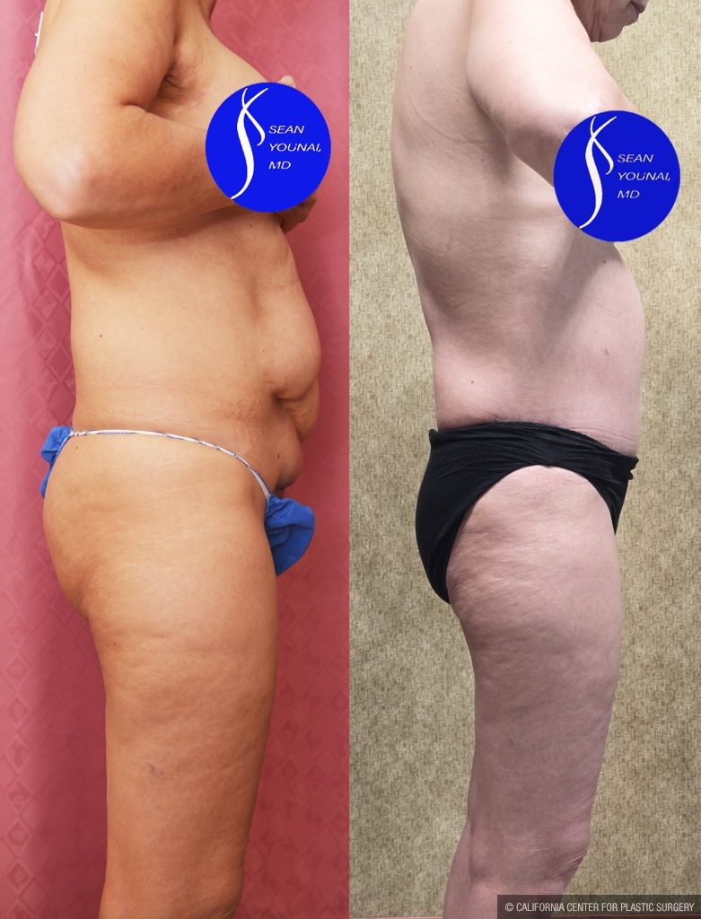 Tummy Tuck (Abdominoplasty) Small Size Before & After Patient #14919