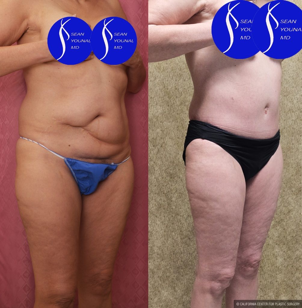Tummy Tuck (Abdominoplasty) Small Size Before & After Patient #14919