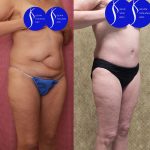 Tummy Tuck (Abdominoplasty) Small Size Before & After Patient #14919