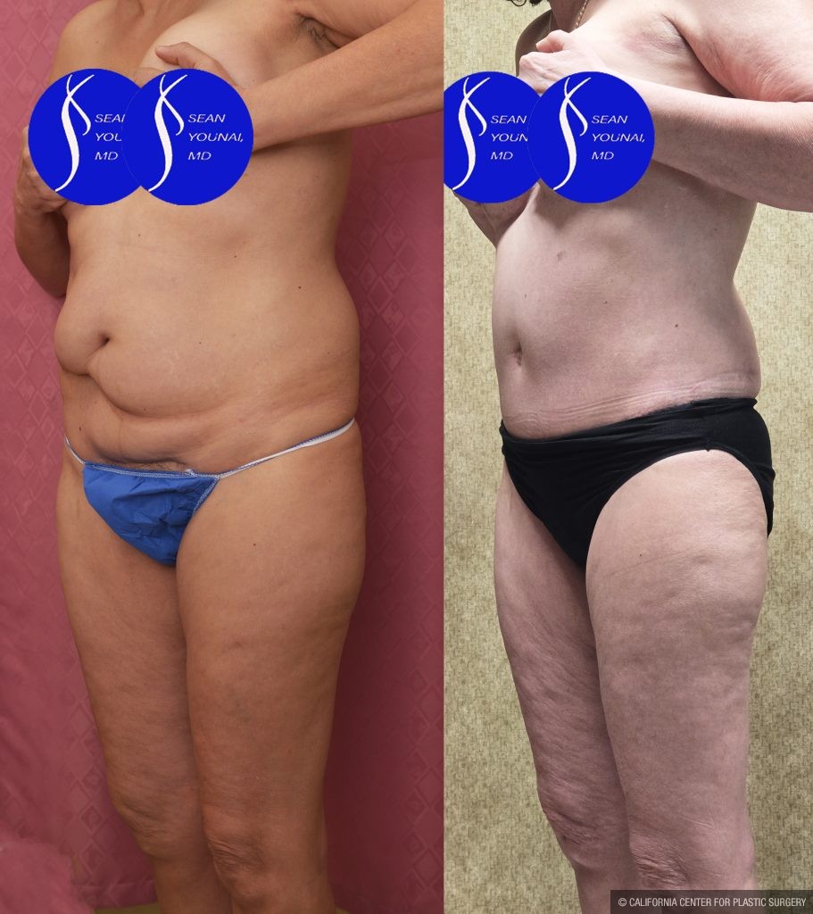 Tummy Tuck (Abdominoplasty) Small Size Before & After Patient #14919