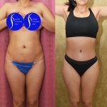 Tummy Tuck (Abdominoplasty) Small Size Before & After Patient #14920