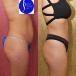 Tummy Tuck (Abdominoplasty) Small Size Before & After Patient #14920