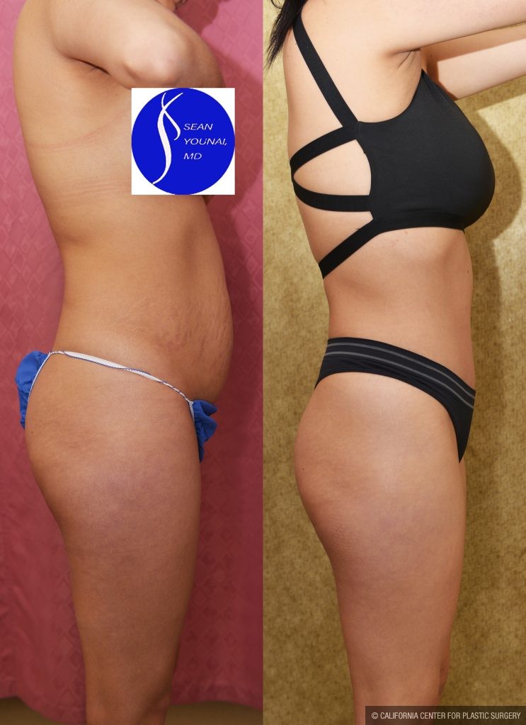 Tummy Tuck (Abdominoplasty) Small Size Before & After Patient #14920