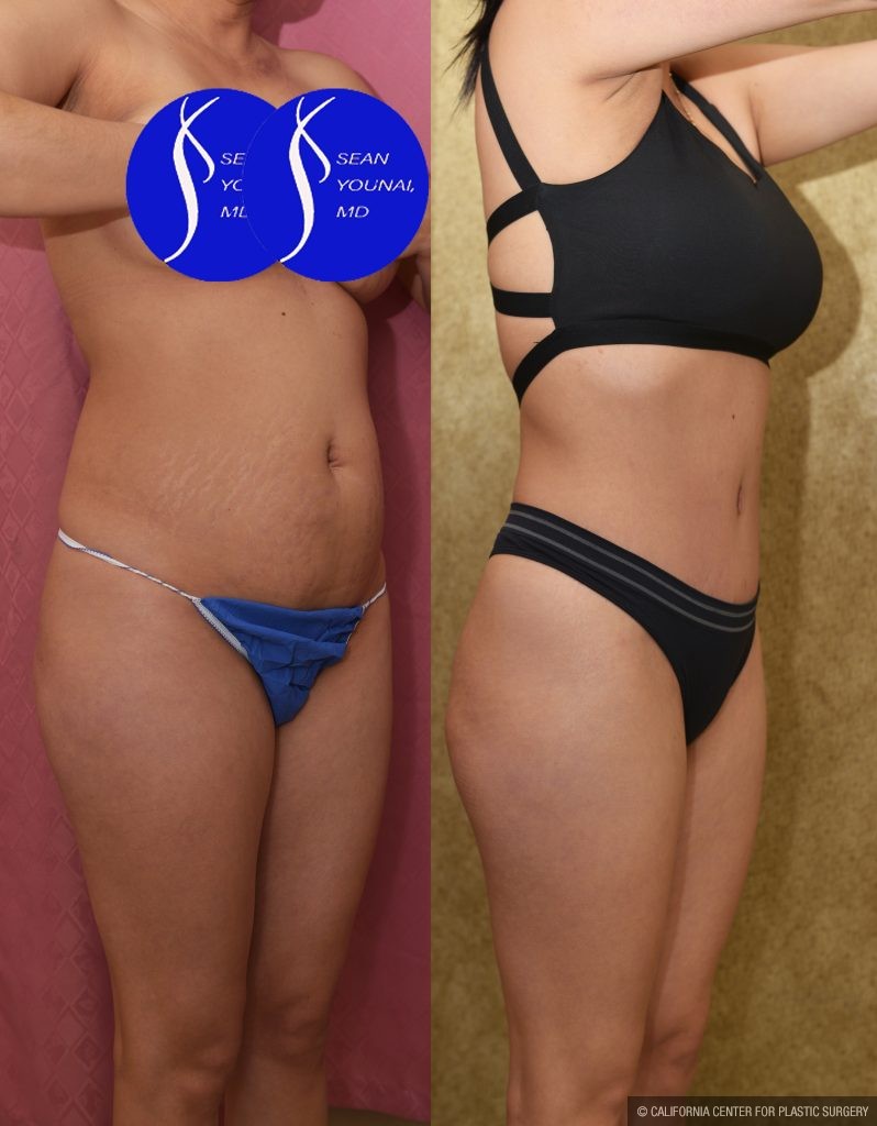 Tummy Tuck (Abdominoplasty) Small Size Before & After Patient #14920