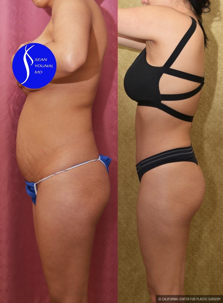 Tummy Tuck (Abdominoplasty) Small Size Before & After Patient #14920