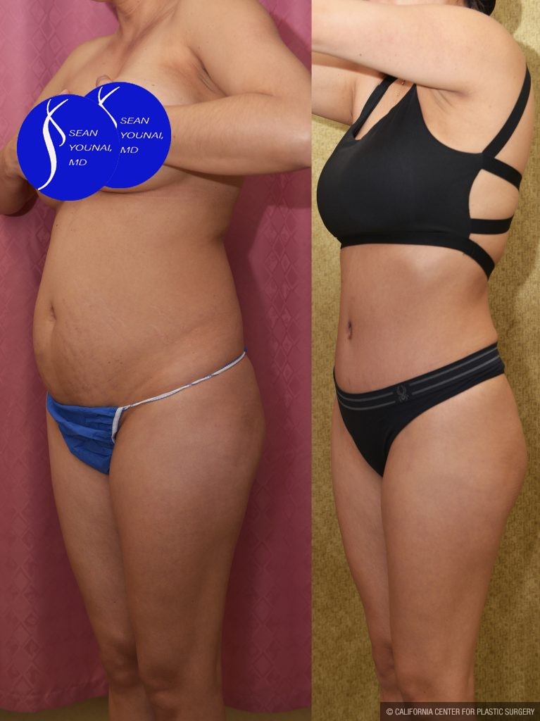Tummy Tuck (Abdominoplasty) Small Size Before & After Patient #14920