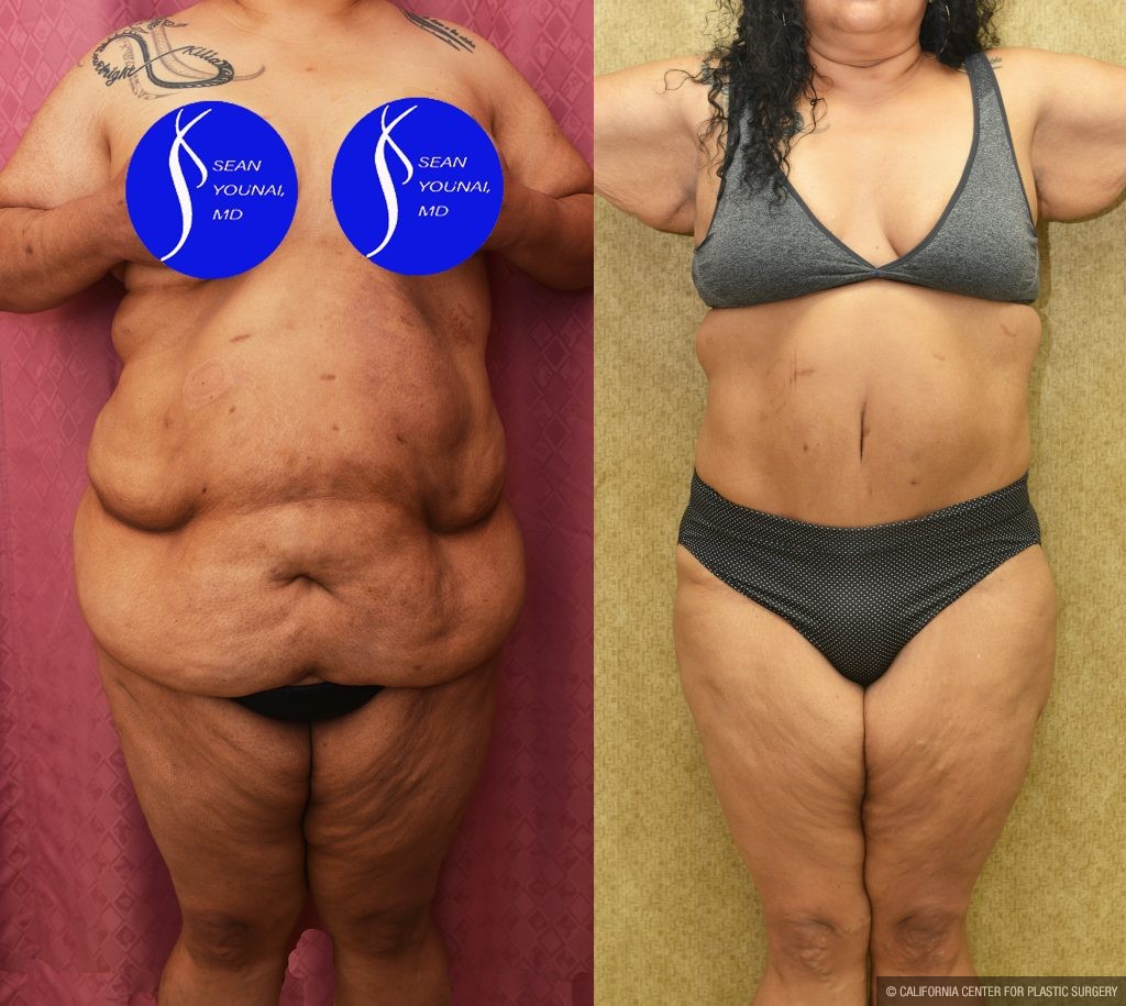 Tummy Tuck (Abdominoplasty) Super Plus Size Before & After Patient #14922