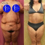 Tummy Tuck (Abdominoplasty) Super Plus Size Before & After Patient #14922