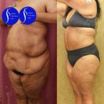 Tummy Tuck (Abdominoplasty) Super Plus Size Before & After Patient #14922