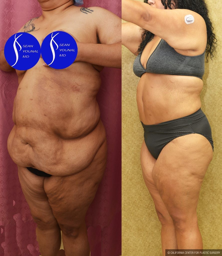Tummy Tuck (Abdominoplasty) Super Plus Size Before & After Patient #14922