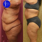 Tummy Tuck (Abdominoplasty) Super Plus Size Before & After Patient #14922