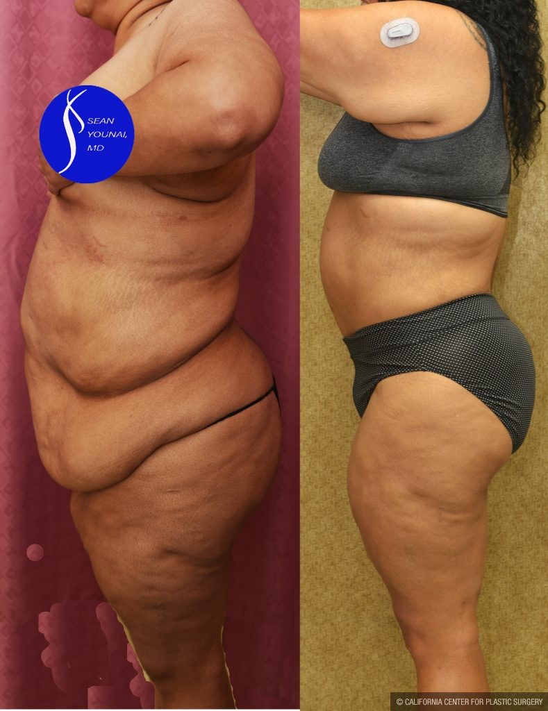 Tummy Tuck (Abdominoplasty) Super Plus Size Before & After Patient #14922