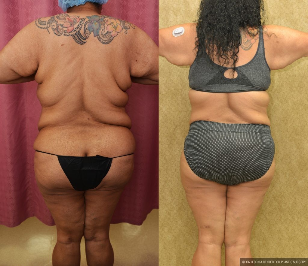 Tummy Tuck (Abdominoplasty) Super Plus Size Before & After Patient #14922