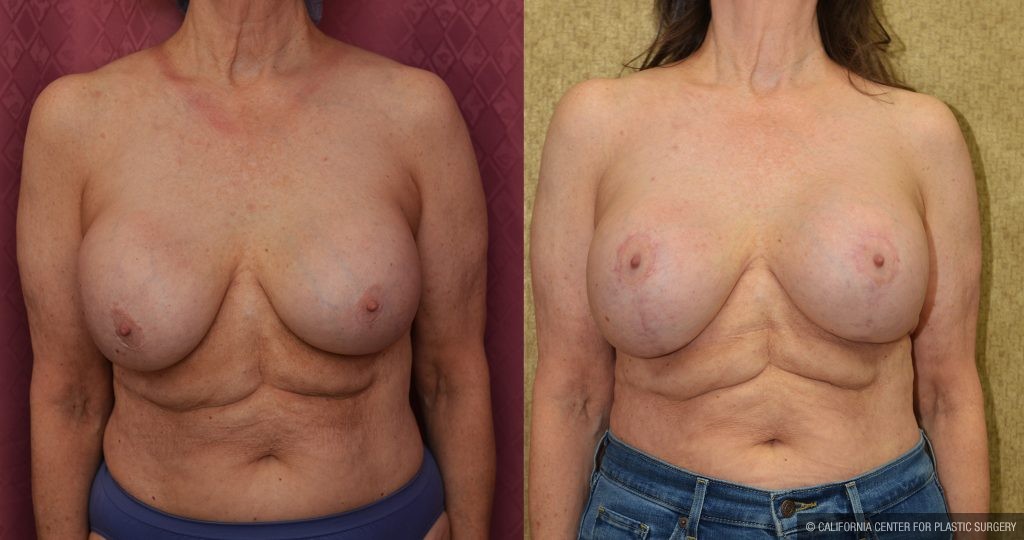 Breast Augmentation (Revision) Before & After Patient #14910