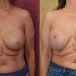 Breast Augmentation (Revision) Before & After Patient #14910