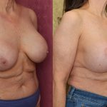 Breast Augmentation (Revision) Before & After Patient #14910