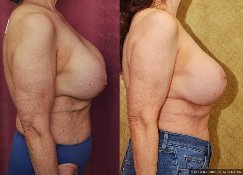 Breast Augmentation (Revision) Before & After Patient #14910
