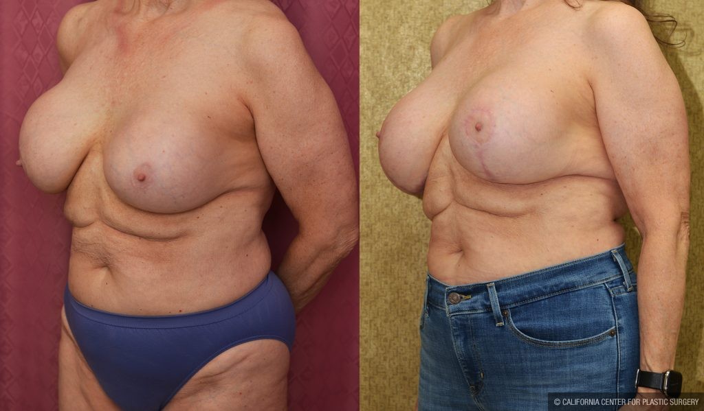 Breast Augmentation (Revision) Before & After Patient #14910