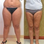Thigh Lift Before & After Patient #14912