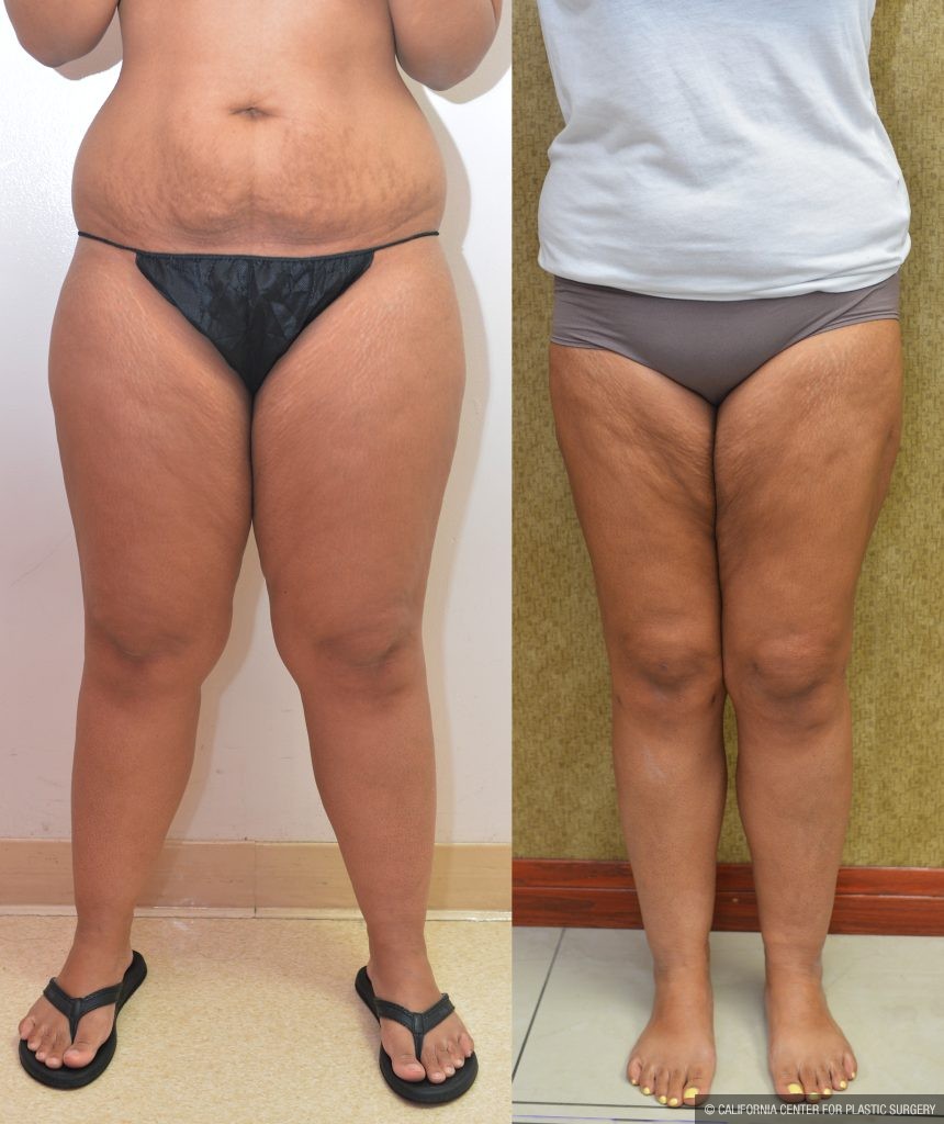 Thigh Lift Before & After Patient #14912