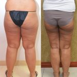 Thigh Lift Before & After Patient #14912