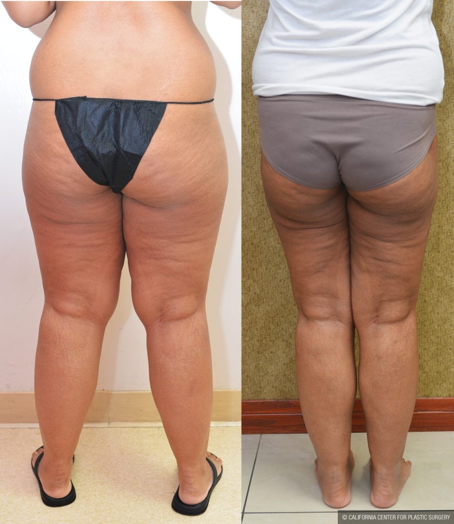 Thigh Lift Before & After Patient #14912