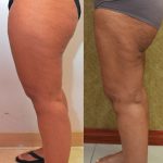 Thigh Lift Before & After Patient #14912