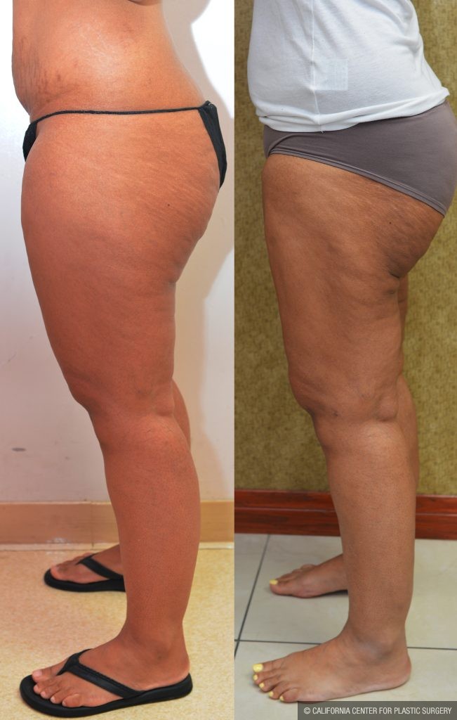 Thigh Lift Before & After Patient #14912
