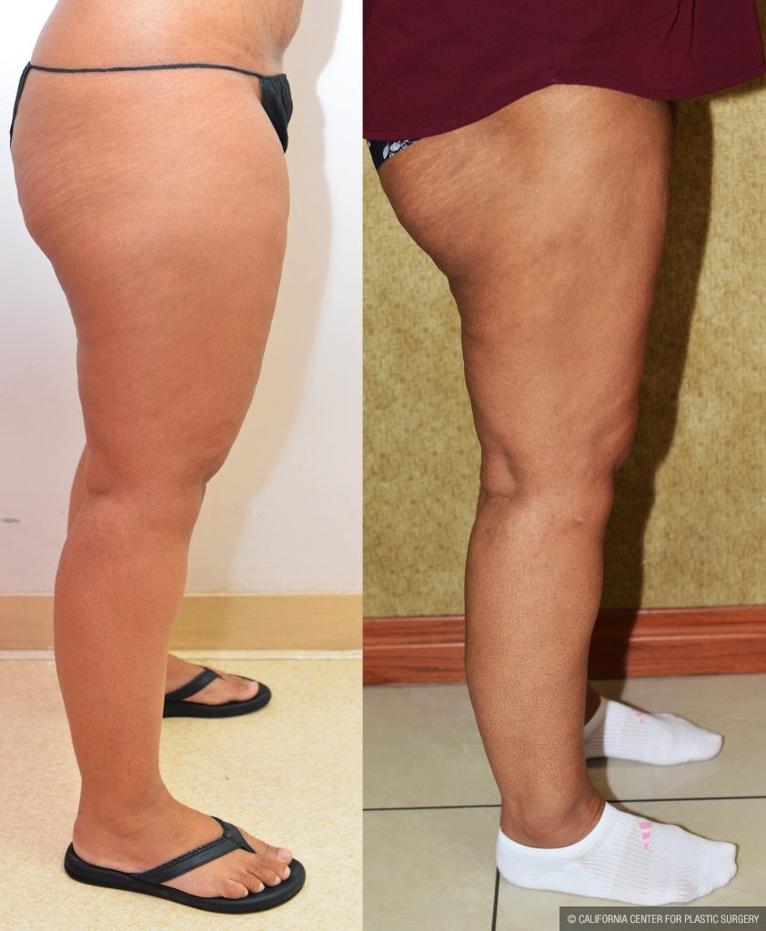 Thigh Lift Before & After Patient #14912