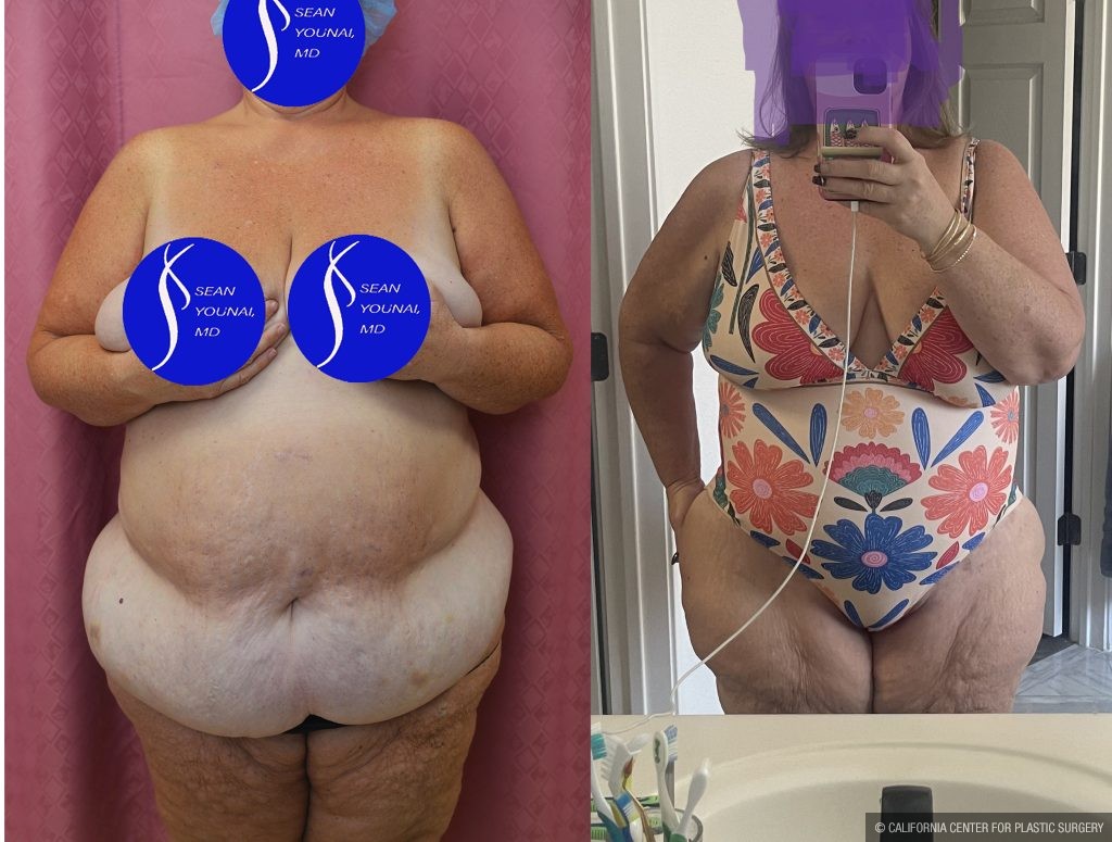 Tummy Tuck (Abdominoplasty) Super Plus Size Before & After Patient #14921