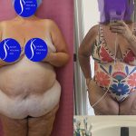 Tummy Tuck (Abdominoplasty) Super Plus Size Before & After Patient #14921
