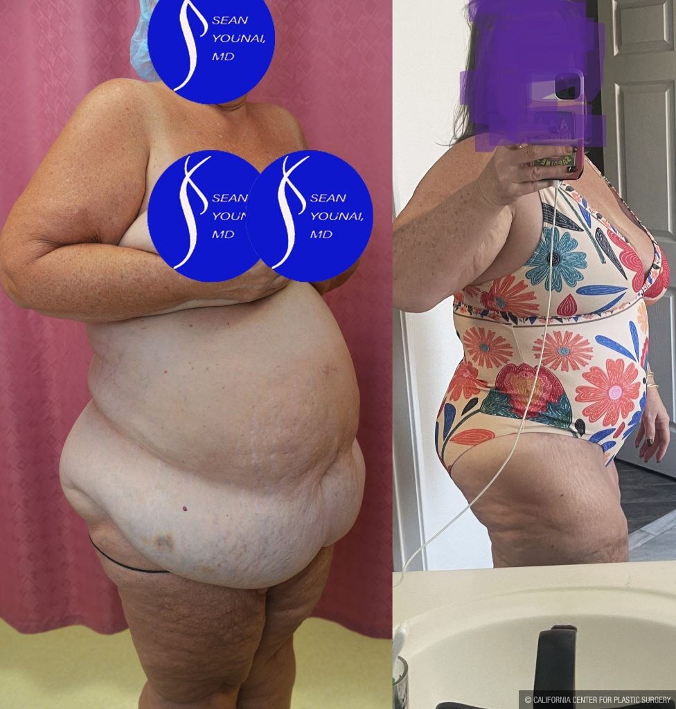 Tummy Tuck (Abdominoplasty) Super Plus Size Before & After Patient #14921