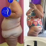 Tummy Tuck (Abdominoplasty) Super Plus Size Before & After Patient #14921