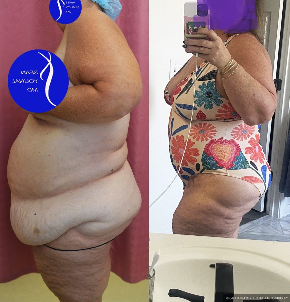 Tummy Tuck (Abdominoplasty) Super Plus Size Before & After Patient #14921
