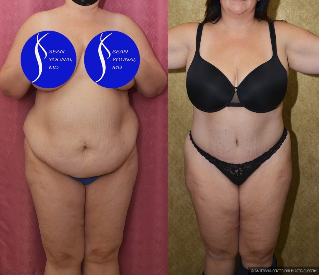 Tummy Tuck (Abdominoplasty) Plus Size Before & After Patient #14916