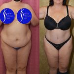 Tummy Tuck (Abdominoplasty) Plus Size Before & After Patient #14916