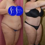 Tummy Tuck (Abdominoplasty) Plus Size Before & After Patient #14916