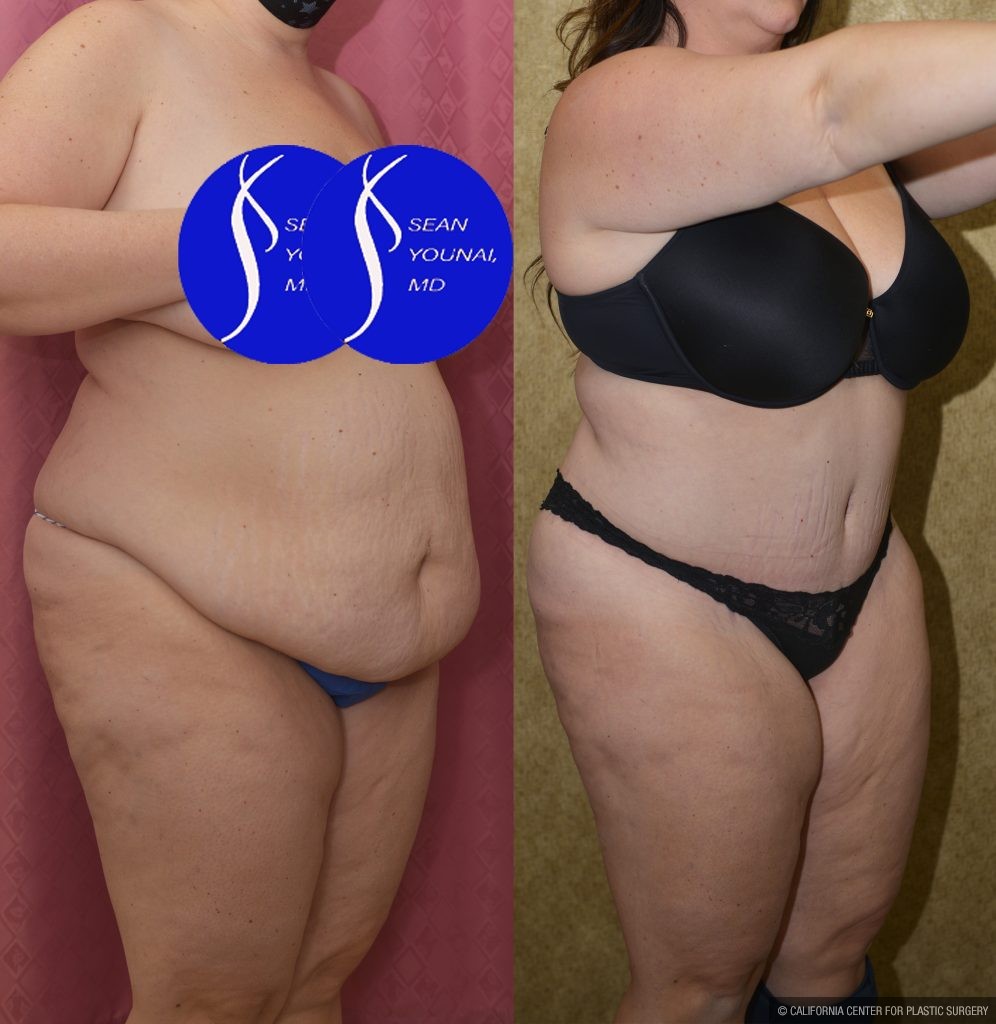 Tummy Tuck (Abdominoplasty) Plus Size Before & After Patient #14916