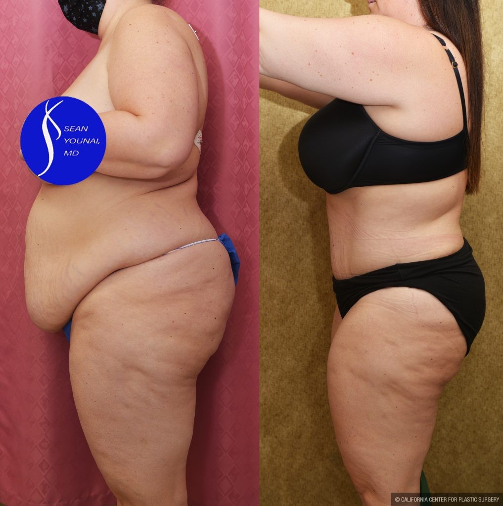 Tummy Tuck (Abdominoplasty) Plus Size Before & After Patient #14916