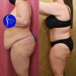 Tummy Tuck (Abdominoplasty) Plus Size Before & After Patient #14916