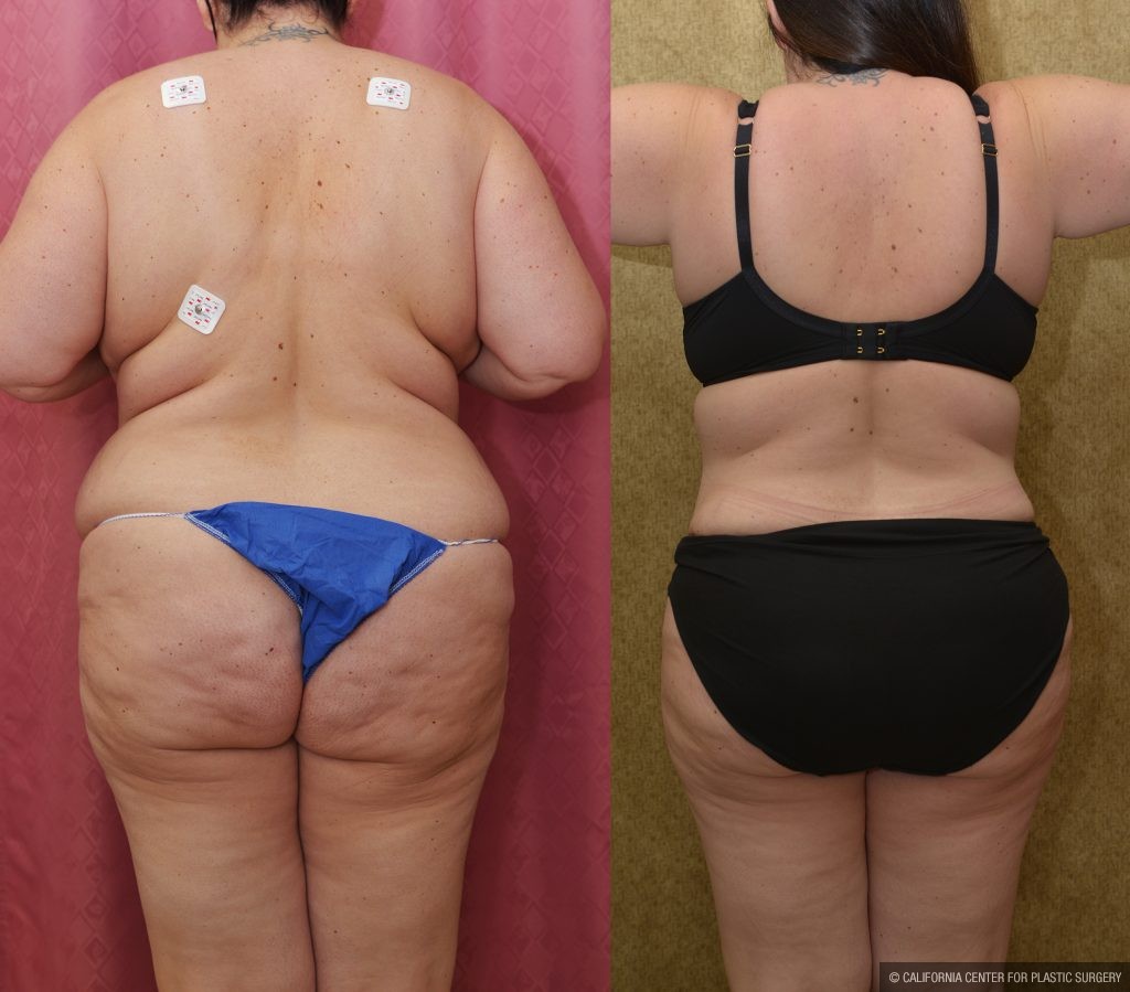 Tummy Tuck (Abdominoplasty) Plus Size Before & After Patient #14916