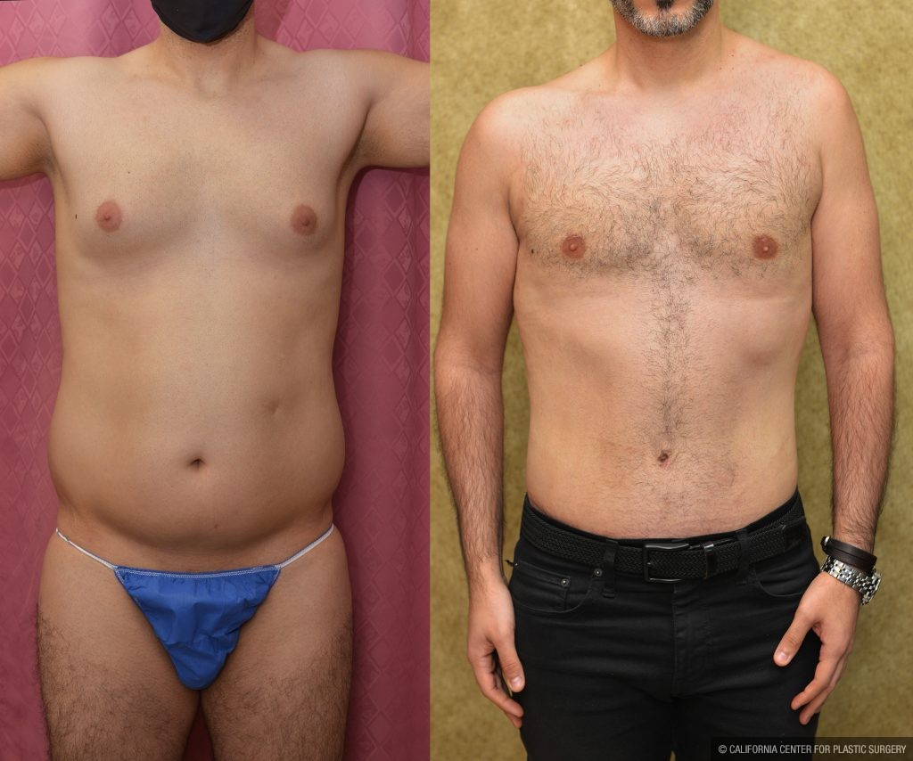 Male Tummy Tuck (abdominoplasty) Before & After Patient #15024