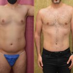 Male Tummy Tuck (abdominoplasty) Before & After Patient #15024