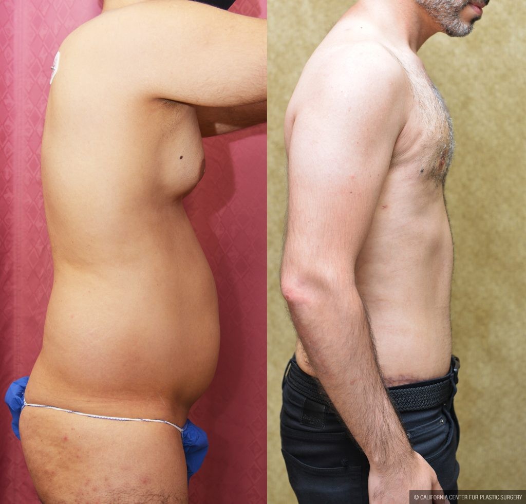 Male Tummy Tuck (abdominoplasty) Before & After Patient #15024