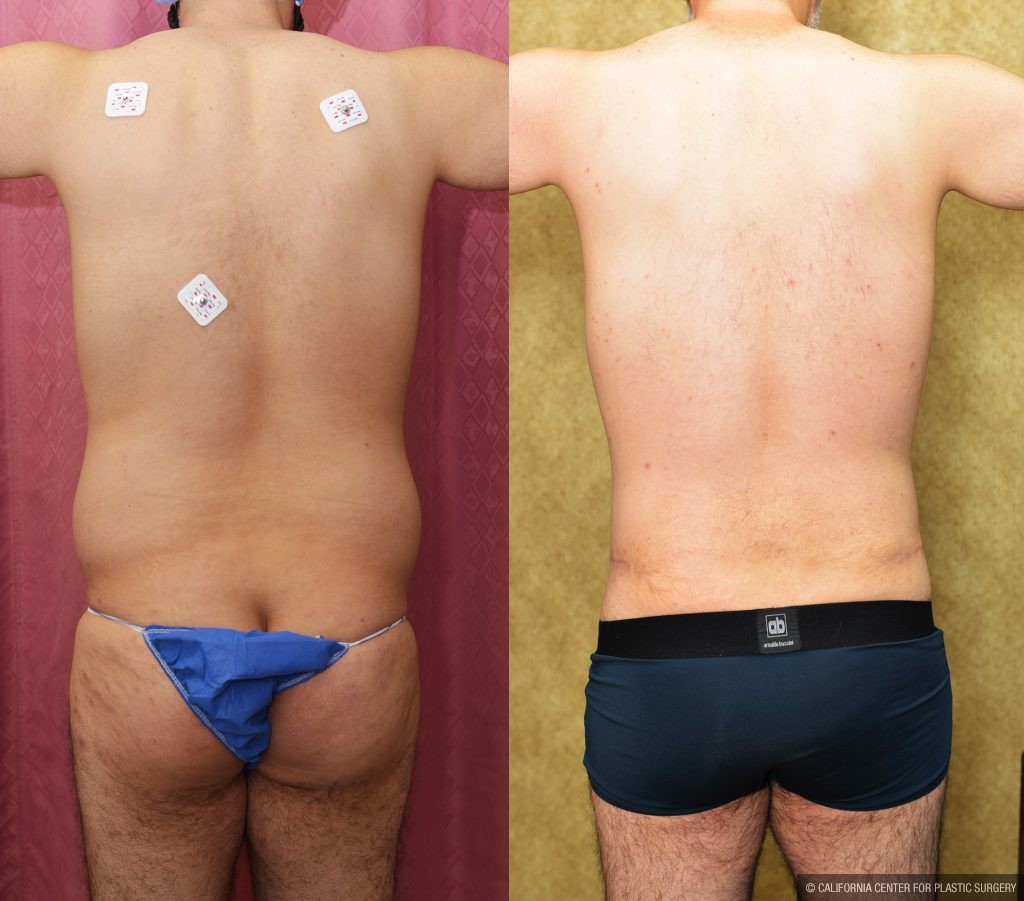 Male Tummy Tuck (abdominoplasty) Before & After Patient #15024